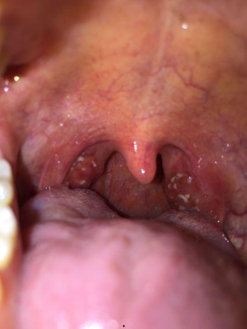 吃冰瓜喉咙就发炎